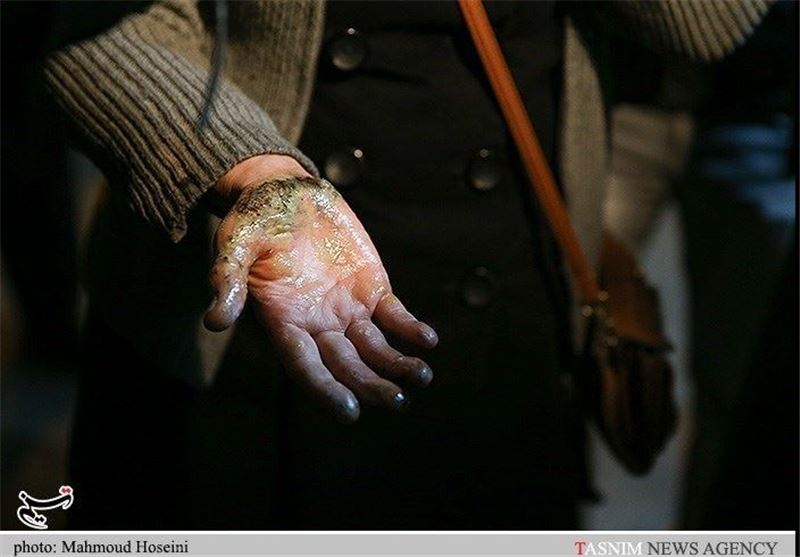 وقوع سالانه 300هزار مورد سوختگی/ تخت سوختگی استاندارد دولتی نداریم