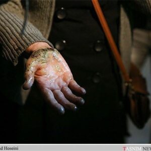 وقوع سالانه 300هزار مورد سوختگی/ تخت سوختگی استاندارد دولتی نداریم