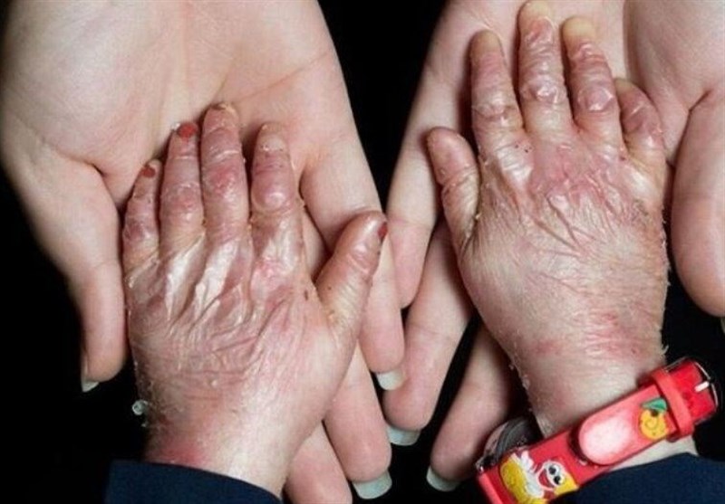 گوشه‌ای از مصائب بیماران پروانه‌ای/دست‌هایی که با پانسمان گره خورده‌اند/ زندگی با بیماری نادر!