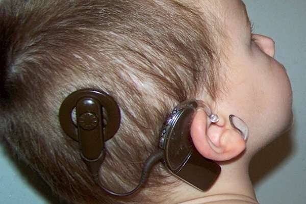 کاشت حلزون در بیمارستان الزهرای زاهدان؛ ۱۷۰ نفر صاحب شنوایی شدند