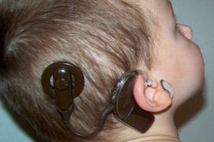 کاشت حلزون در بیمارستان الزهرای زاهدان؛ ۱۷۰ نفر صاحب شنوایی شدند