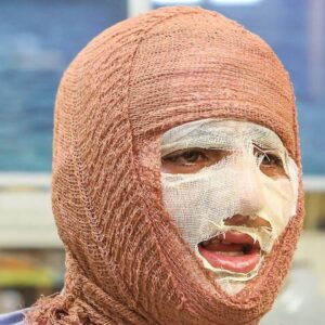 ۸۵ درصد سوختگی‌ها با روش‌های ساده قابل پیشگیری است