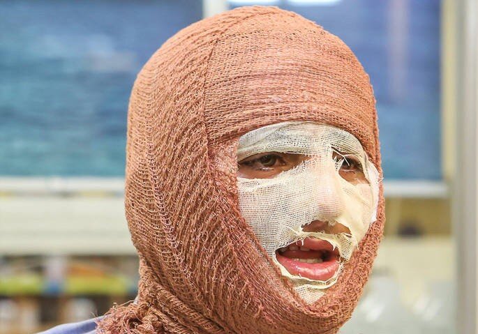 منطقه کاشان بیمارستان تخصصی سوختگی ندارد