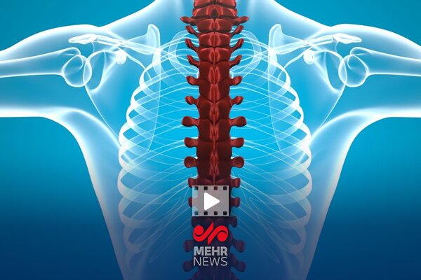 فلج اندام‌ها از عوارض شکستن قلنج توسط ماساژورها