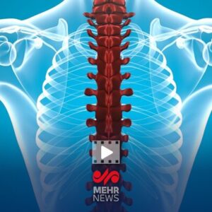 فلج اندام‌ها از عوارض شکستن قلنج توسط ماساژورها