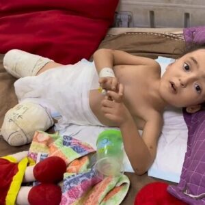 افزایش نگران کننده معلولیت‌های مادرزادی و جنگی در غزه