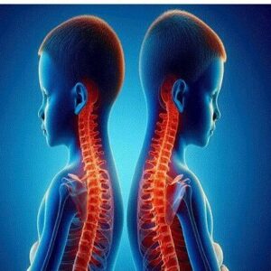 اسکولیوز تهدید خاموش ستون فقرات کودکان است؛ از هر ۲۰ نفر یک مبتلا