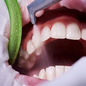 جرم‌گیری، راهی موثر برای پیشگیری از پوسیدگی و بیماری لثه